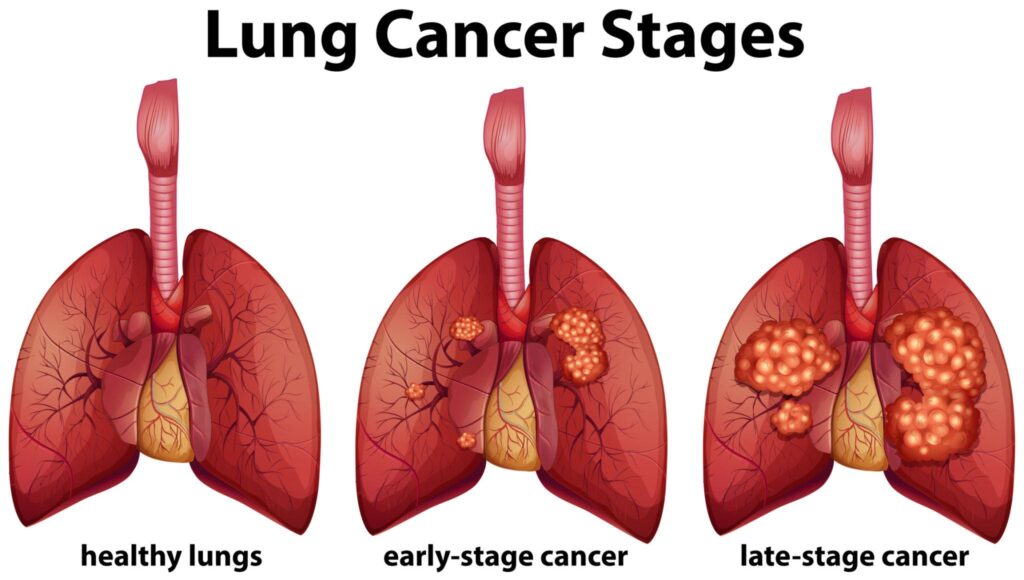 Advanced Stage Lung Cancer